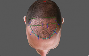 a computer generated image of a man with a robotic hair transplant.