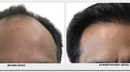 ARTAS Before & After robotic hair transplant procedure with Doctor Yates