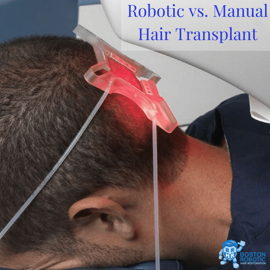 manual vs robotic man undergoes robotic hair transplant